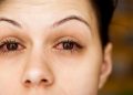 chlamydia eye discharge